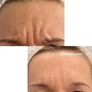 Ботокс межбровная