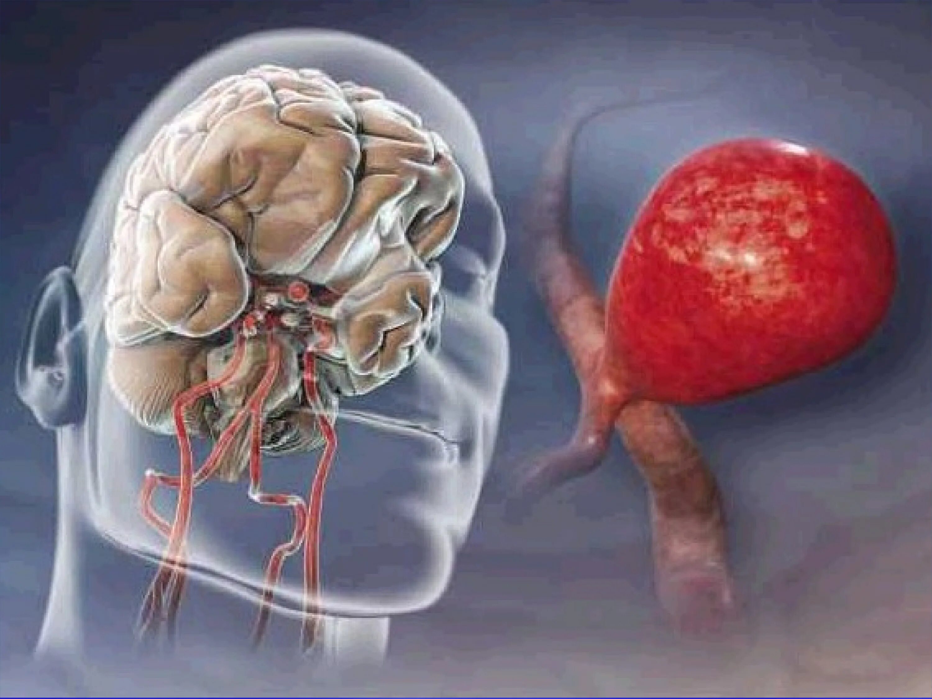 Аневризма головного мозга операция инсульт. Аневризма головного сосудов головного мозга. Церебральная аневризма головного мозга это. Аневризма сосудов головного мозга симптомы. Аневризма мозга простыми словами