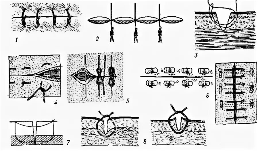 Техника наложения хирургических швов. Петлевидный шов хирургия. Хирургические швы в ветеринарии. Наложение хирургических швов Ветеринария. Узловатый шов хирургия.