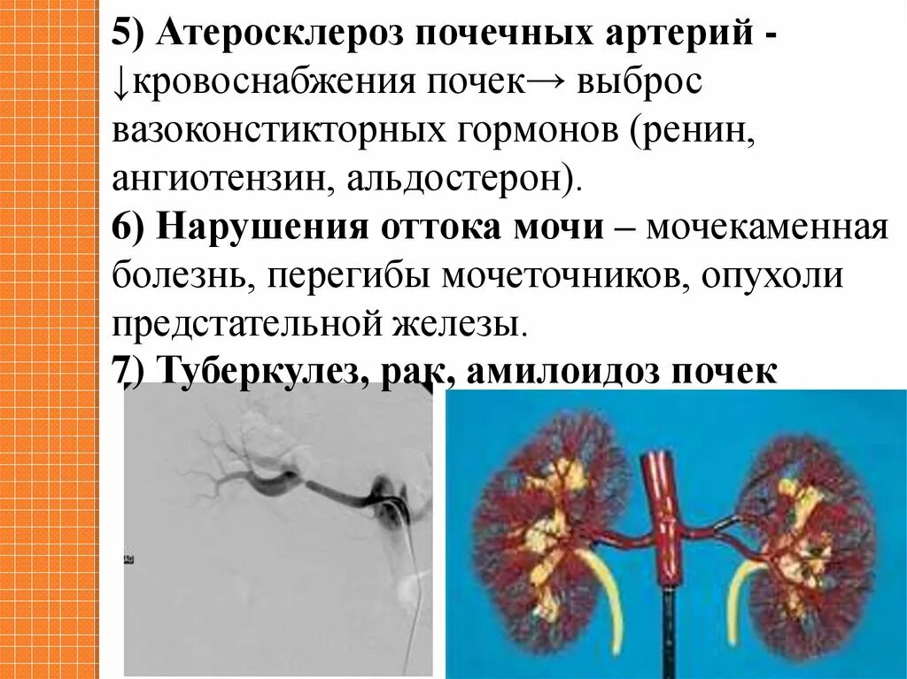 Атеросклероз почечных артерий симптомы. Атеросклероз почечных артерий клинические проявления. Изменения почек при атеросклерозе почечных артерий. Осложнения атеросклероза почечных артерий.