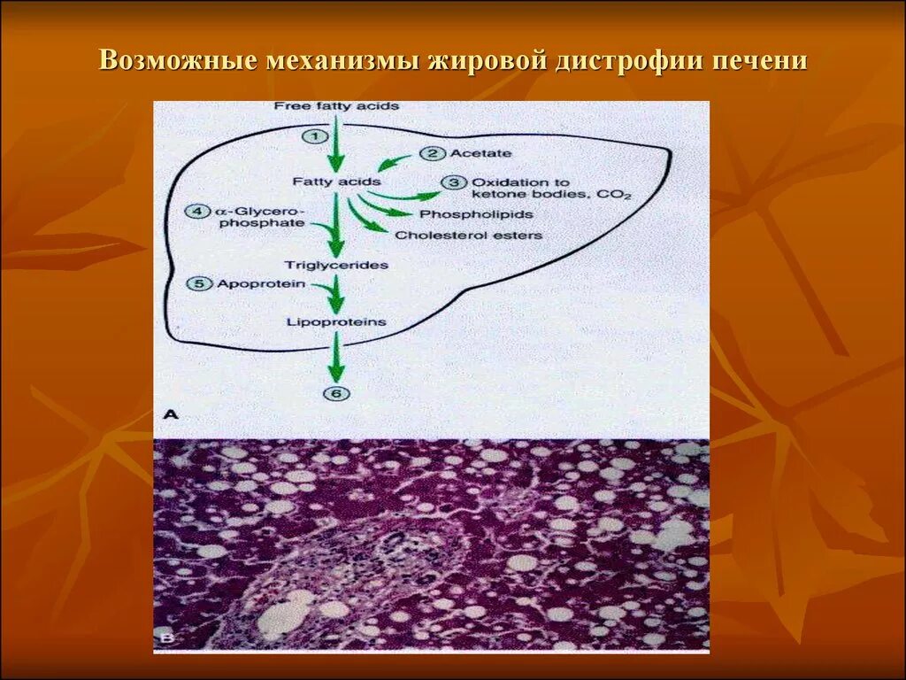 Дегенерация печени к 76.0. Внутриклеточные накопления жировая дистрофия. Жировая дистрофия печени биохимия. Паренхиматозные жировые дистрофии механизм развития. Паренхиматозная дегенерация печени.