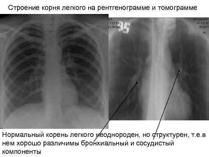 Корни легких структурны что это. Структура корня легкого на рентгенограмме. Патология корня легкого на рентгенограмме заболевания. Корень легкого на рентгенограмме в норме. Корень легкого в норме на рентгене.