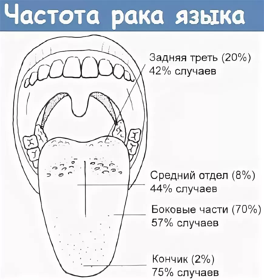 Опухоль корня языка симптомы. Новообразование сбоку языка. Ракяз. Какой размер языка