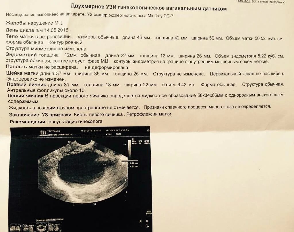 Норма полости матки. Киста яичника на УЗИ описание. УЗИ органов малого таза киста яичника. Киста яичника заключение УЗИ. УЗИ малого таза киста яичника заключение.