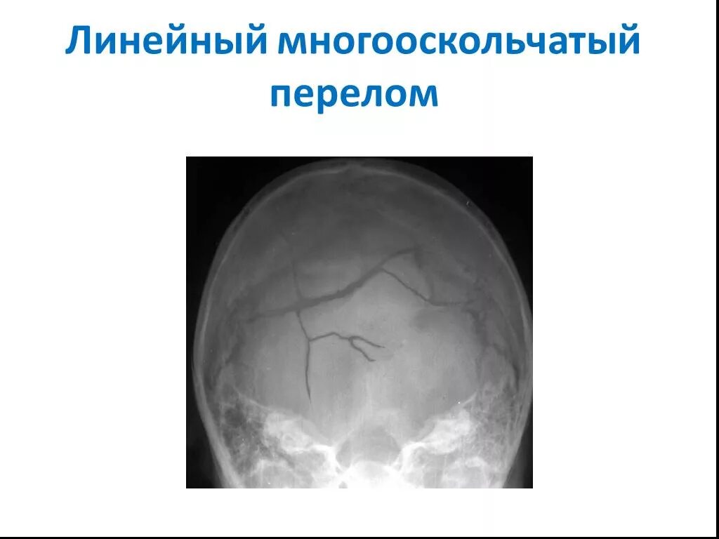 Перелом кости свода черепа. Перелом теменной кости черепа рентген. Перелом костей свода черепа кт. Перелом теменной кости на кт. Оскольчатый перелом костей черепа.