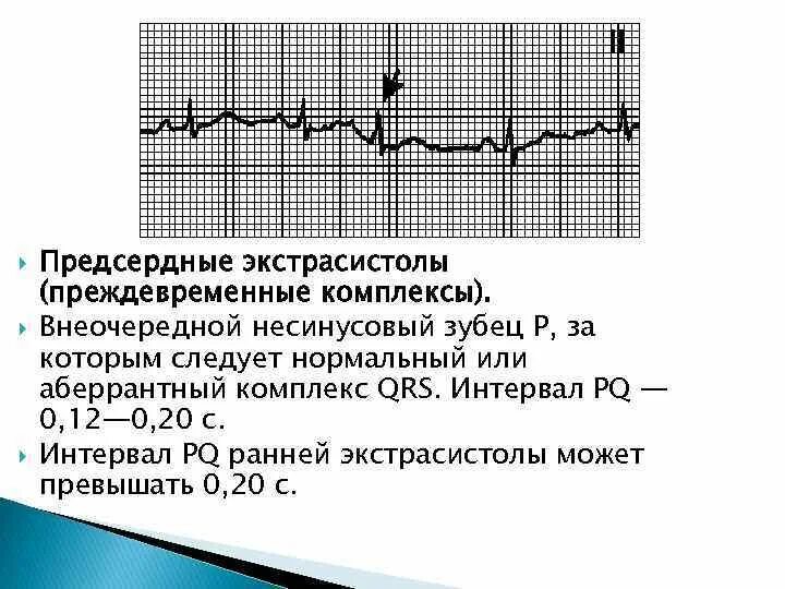 Абберантные предсердные экстрасистолы ЭКГ. Предсердные экстрасистолы на ЭКГ. Внеочередной комплекс QRS. Наджелудочковые экстрасистолы с аберрантным проведением. Блокированные экстрасистолы