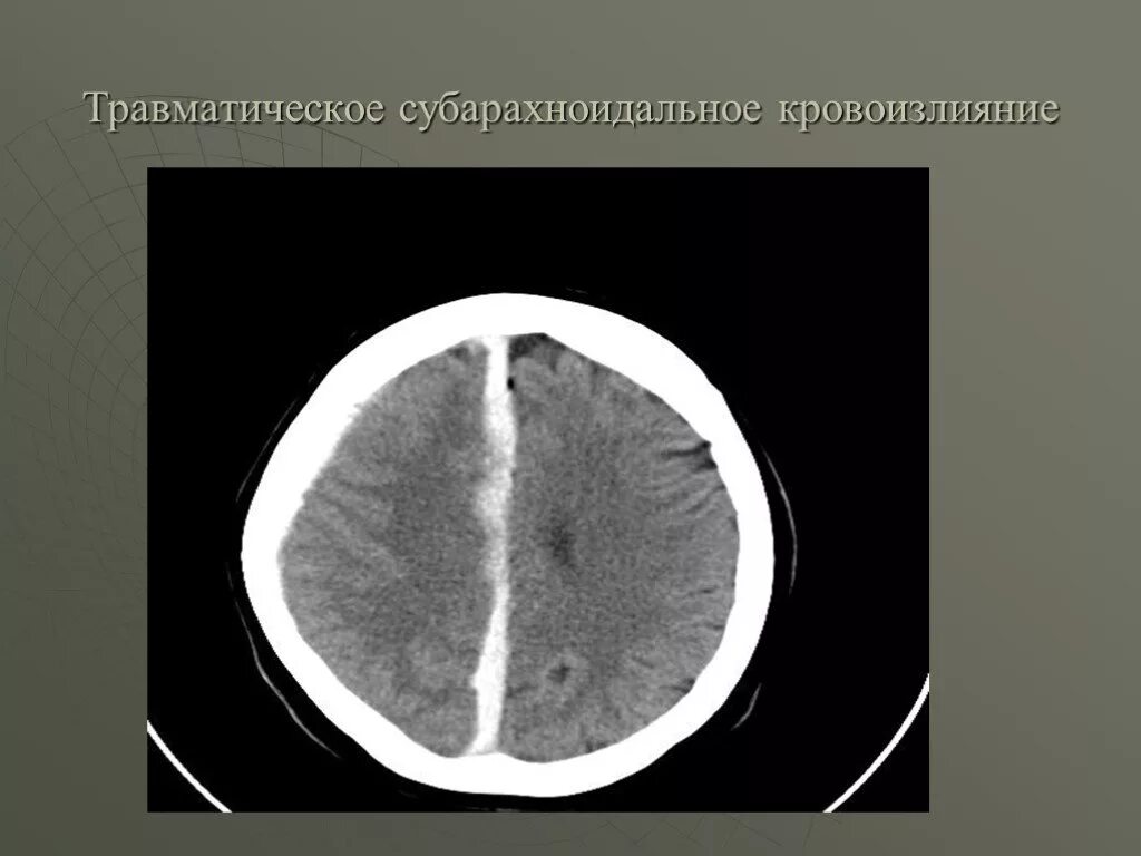 Субарахноидальное кровоизлияние головного мозга на кт. ЗЧМТ субарахноидальное кровоизлияние. Нейровизуализация субарахноидального кровоизлияния. Субарахноидальное кровоизлияние мозжечка кт.