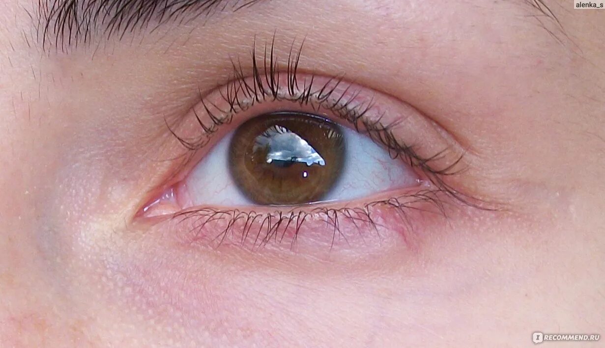 Дипроспан глаза отзывы. Введение дипроспана в полость халязиона. Введение кеналога в халязион. Введение дипроспана в халязион. Доктор михайлов смас лифтинг.