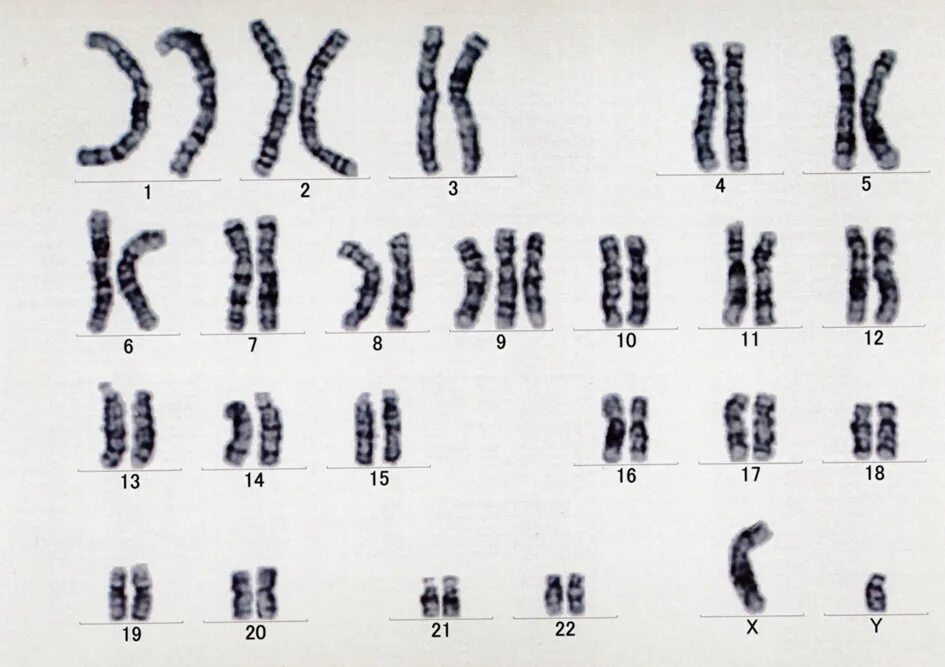 Удвоение хромосом какая мутация. Синдром трисомии хромосомы 8 кариотип.