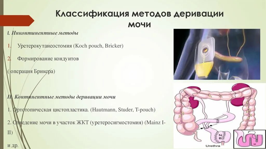 Операция штудера и брикера. Операция брикера уретероилеокутанеостомия что это. Цистэктомия операция брикера. Радикальная цистэктомия мочевого пузыря. Операция брикера мочевого пузыря.