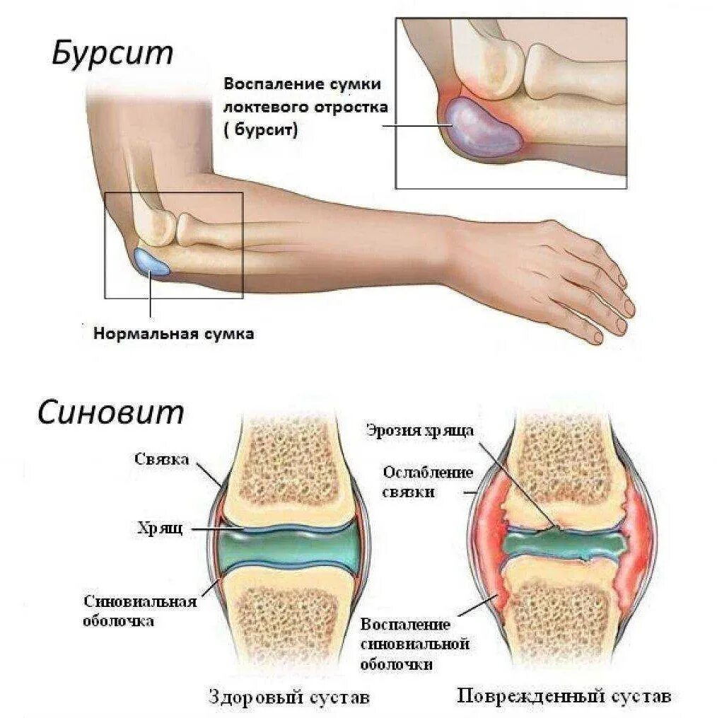 Синовит это. Синовит локтевого сустава. бурмит отростка локтевого. гнойный бурсит локтевого отростка. бурсит воспаление суставной сумки.