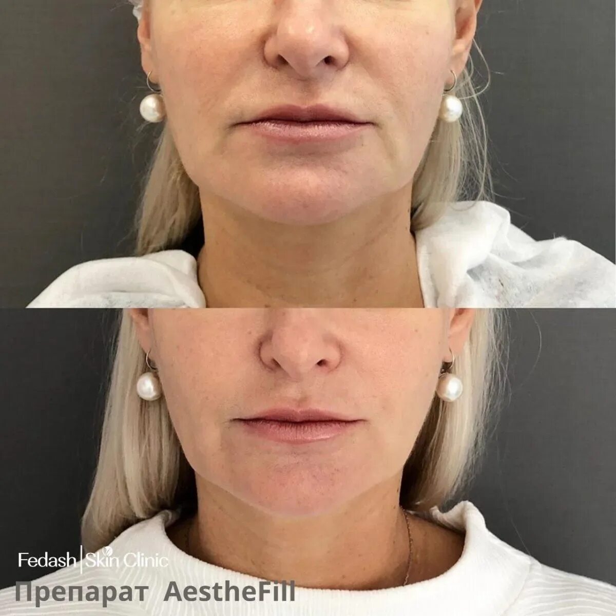 Скульптра Sculptra до и после. Sculptra полимолочная кислота. Полимолочная кислота AESTHEFILL. Полимолочная кислота до и после.