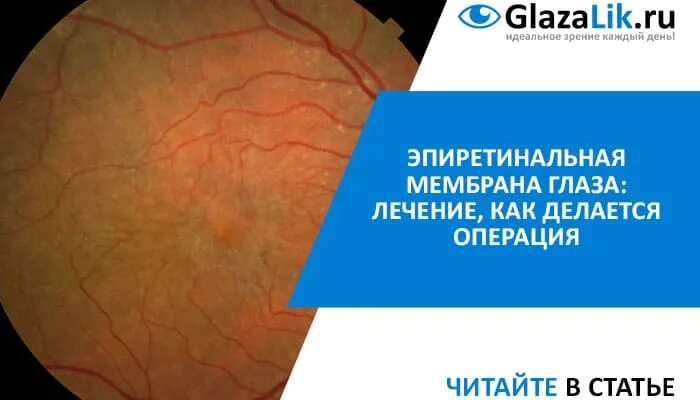 Эпиретинальный фиброз глаза что это. Эпиретинальная мембрана офтальмоскопия. глазное дно эпиретинальный фиброз. эпиретинальная мембрана операция. макулярная эпиретинальная мембрана глаза.