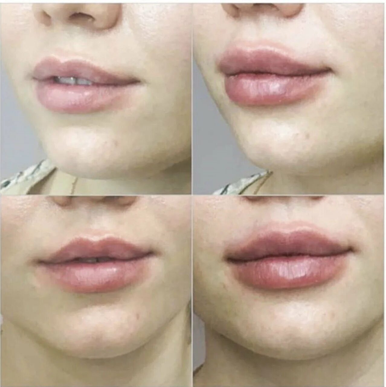 Уголки губ до и после. Приподнятые уголки губ. Увеличение губ приподнять уголки губ.