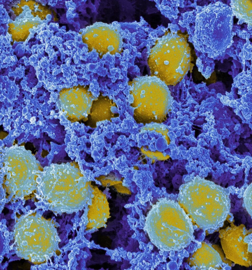 Стафилококк золотистый Staphylococcus aureus. S. aureus золотистый стафилококк. Метициллин-резистентный золотистый стафилококк. Бактерия стафилококк ауреус.