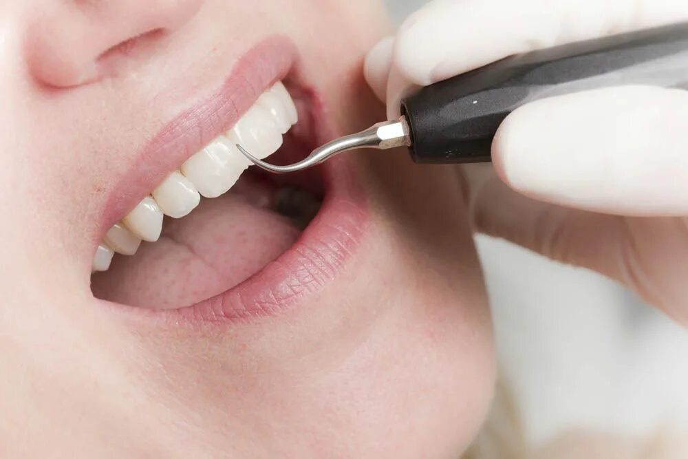 Профгигиена (ультразвук + Air-Flow). Пародонтит зубной камень. Профессиональная гигиена полости рта. Профессиональная гигиена зубов.