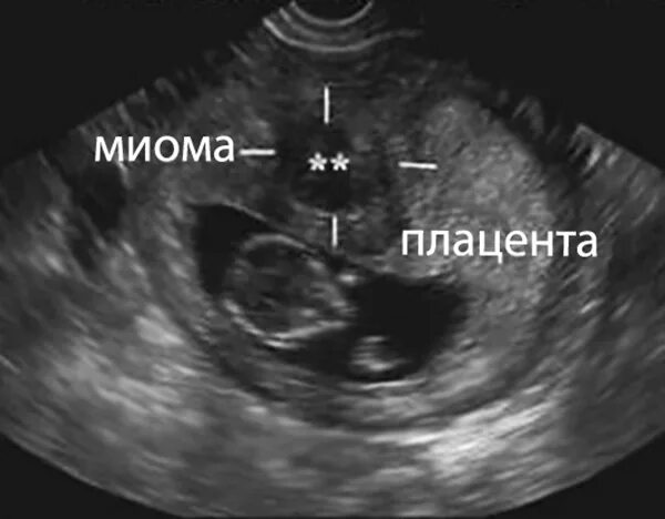 Субмукозная миома матки УЗИ. Миома матки при беременности УЗИ. Матка увеличена до 6 недель