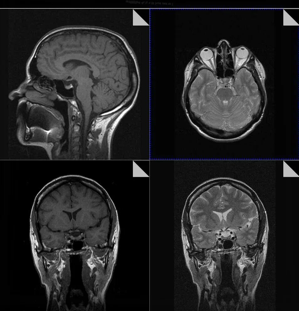 Мрт с контрастом головного. Микроаденома гипофиза мрт. Аденома гипофиза мрт. Микроаденома гипофиза головного мозга мрт. Мрт микроаденома гипофиза мрт.