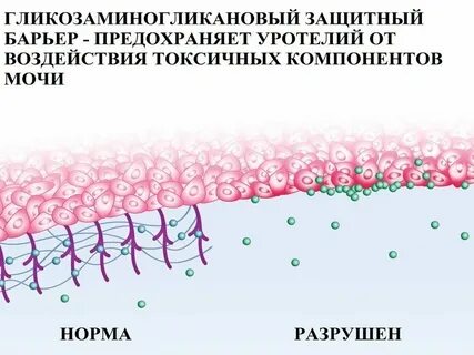 Интерстициальный цистит у женщин