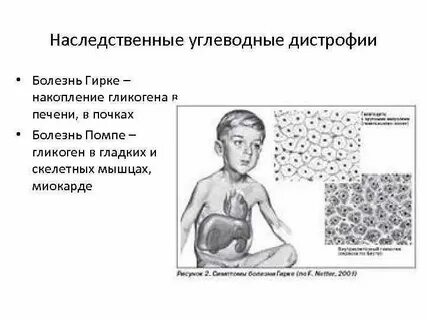 Генетическая мышечная дистрофия