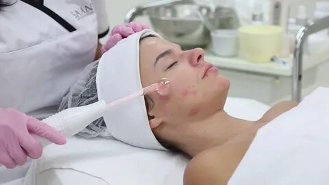 Дарсонваль от акне