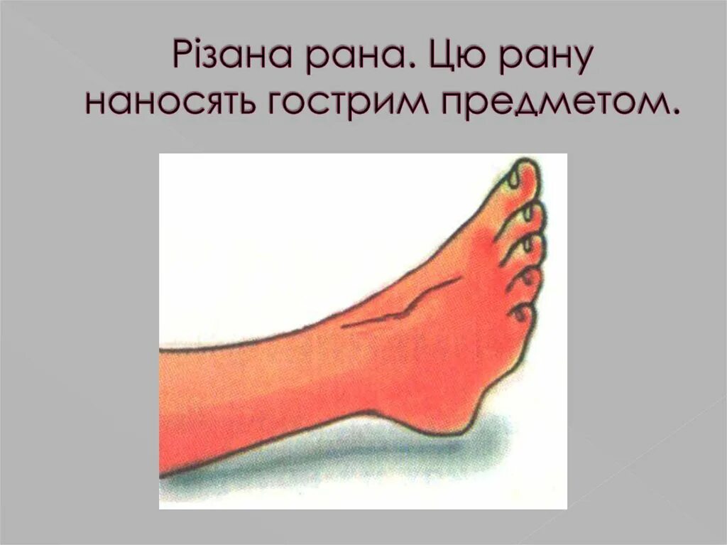 Тест по теме рана. Резаная рана наносится. резаные раны поверхностные.