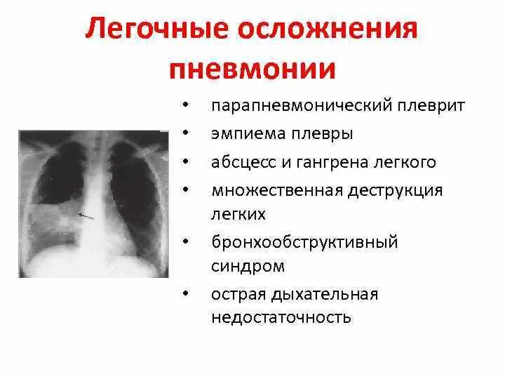 Пневмония признаки у взрослых. Осложнения после внебольничной пневмонии. Плеврит осложнение пневмонии. Пульмональные симптомы пневмонии. Диагностика легочных осложнений пневмонии.