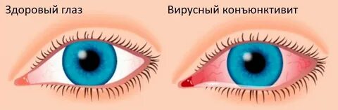 При конъюнктивите можно на улицу