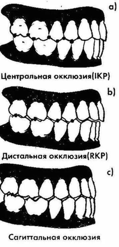 Что значит окклюзия. Передняя окклюзия зубных рядов. центральная окклюзия это в стоматологии. центральная боковая окклюзия. дистальная окклюзия 4мм.