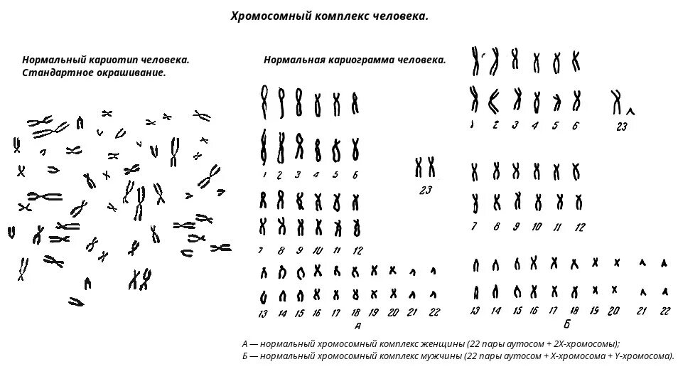 Схема хромосомного набора. Кариотип человека хромосомы. Метафазная пластинка человека мужской кариотип. Кариограмма схема кариотипа человека. Схема нормального кариотипа человека.