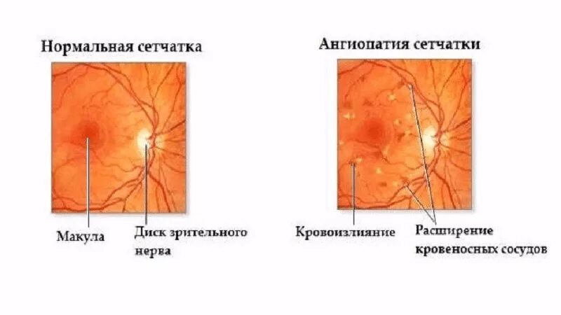 Ангиопатия сосудов глазного дна. Ангиопатии сосудов сетчатки. Гипертоническая ангиопатия сетчатки. Диабето-гипертоническая ангиопатия сетчатки. Ангиопатия сосудов сетчатки что это