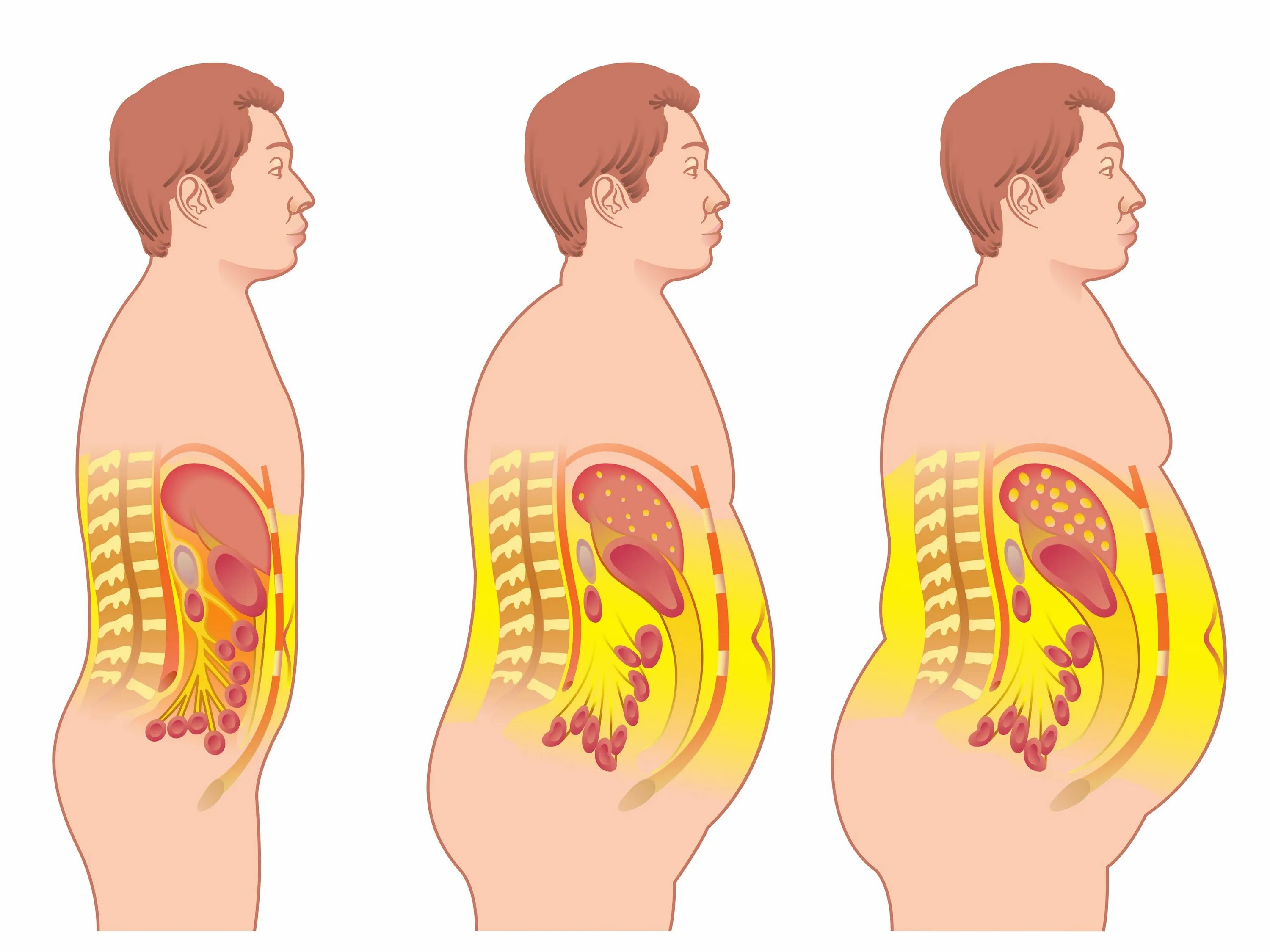 Висцеральный жир анатомия. Висцеральное ожирение. Толстый человек анатомия