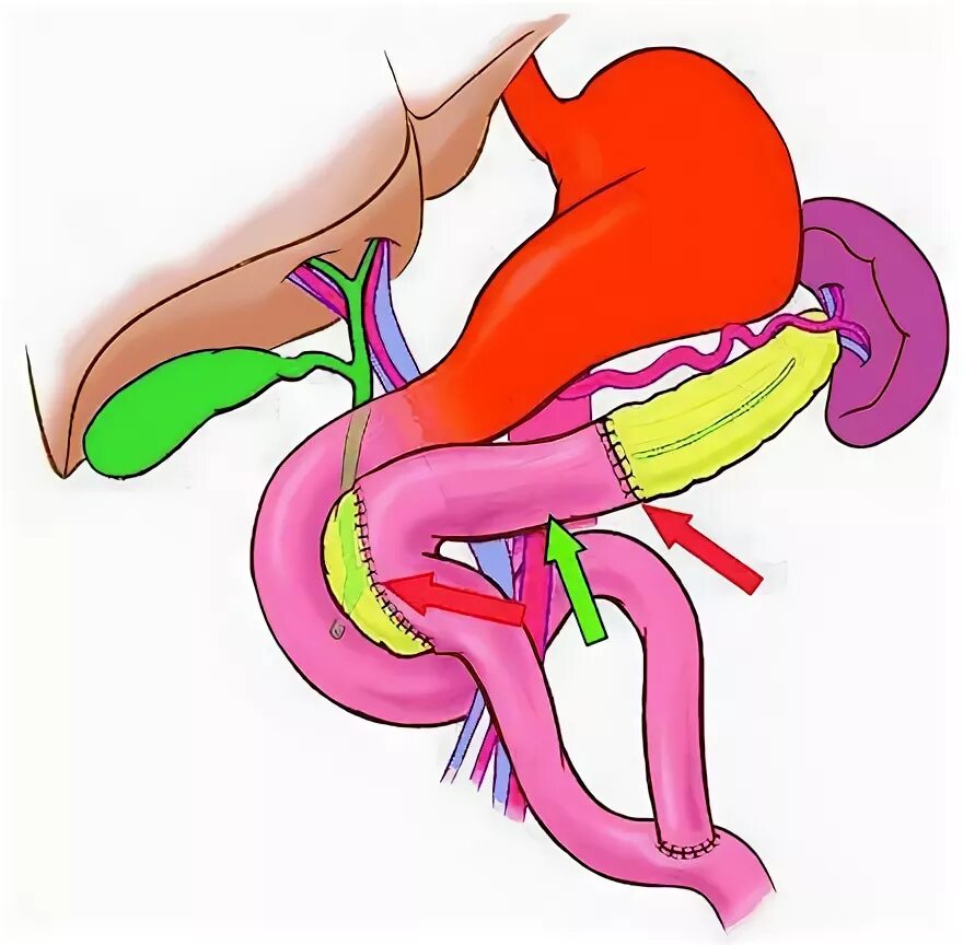 Поджелудочная железа операция. Операция Бегера на поджелудочной железе схема.
