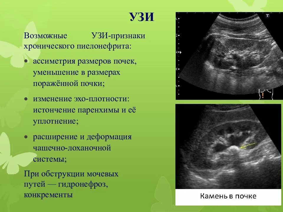 Очаговые изменения почки. Хронический пиелонефрит УЗИ. УЗИ почек при остром пиелонефрите у детей заключение. УЗИ критерии хронического пиелонефрита.