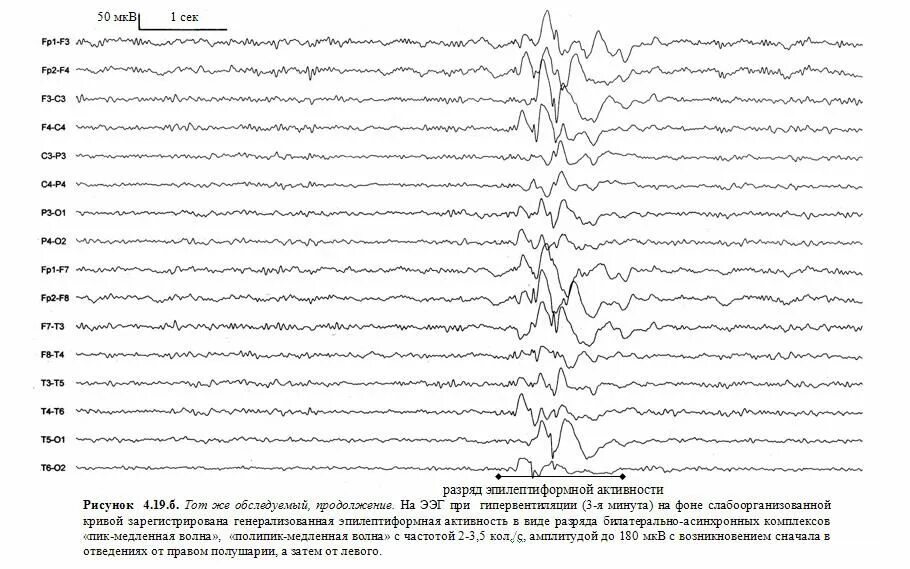 Вертексные потенциалы на ЭЭГ. Эпилептиформная активность на ЭЭГ. ЭЭГ паттерн Дэрд. ЭЭГ при энурезе у детей. Изменения бэа головного мозга что это