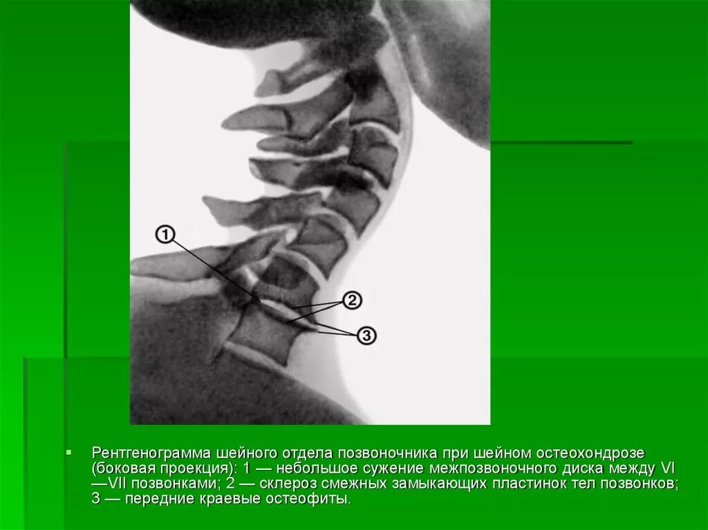 Склероз замыкательных пластинок позвоночника. Замыкающие пластинки тел позвонков. Замыкательные пластины позвонков. Шейный отдел позвоночника. Остеохондроз позвоночника.