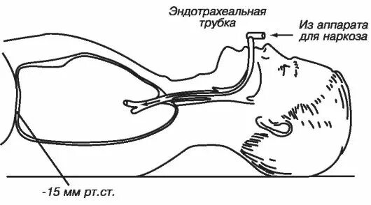 Трубка при наркозе. Эндотрахеальная трубка для наркоза. Ингаляционный наркоз эндотрахеальный. Наркоз трубка интубационная. Интубационный эндотрахеальный наркоз.