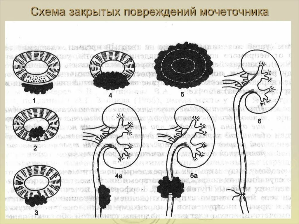 Классификация повреждений мочеточника. Травма мочеточника классификация. Травматическое повреждение мочеточников. Классификация,. Закрытые и открытые повреждения мочеточник. Иррадиация по ходу мочеточника