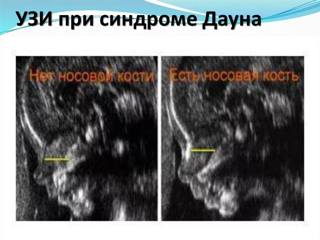 Ксс у плода. Показатели синдрома Дауна на УЗИ. Носовая кость Дауна на УЗИ. УЗИ плода с синдромом Дауна. Синдром Дауна на УЗИ 12 недель.