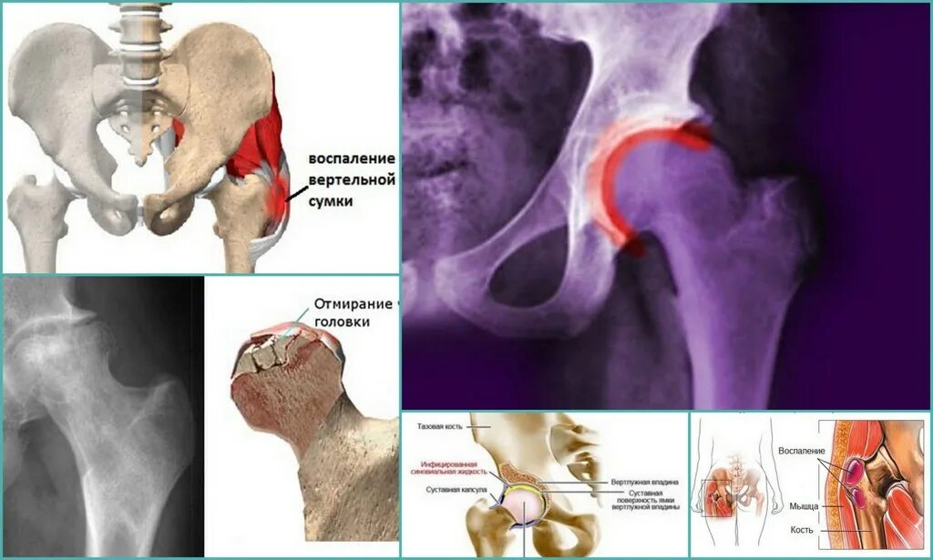 Тазобедренная боль у женщин причины и лечение. Тазобедренный сустав болит. Боль в головке бедренной кости. Гематома тазобедренного сустава.