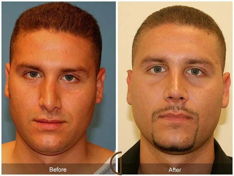 Мужчины после операции. Ринопластика до и после мужчины. Нос картошкой ринопластика мужчин. Пластика носа картошкой мужчин.
