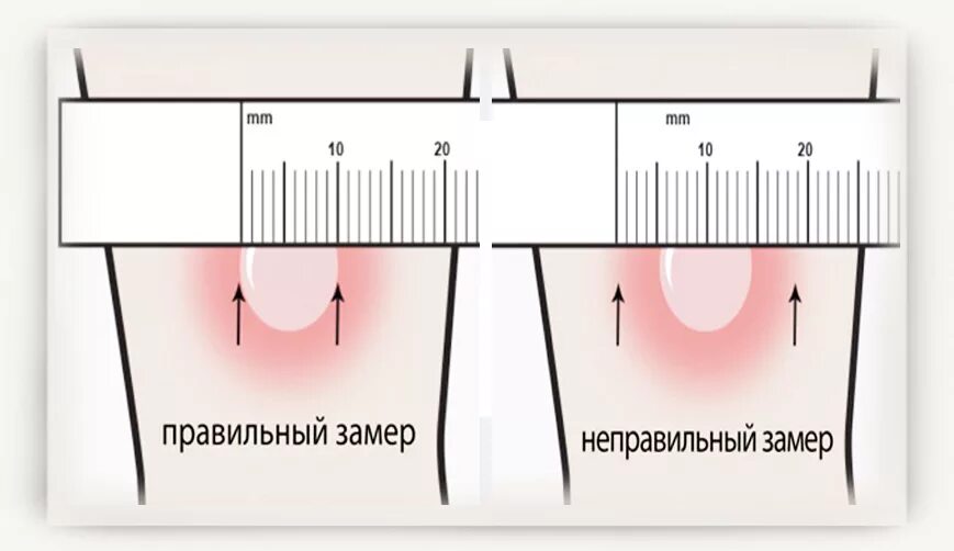 Нормы размеров папулы манту у детей. Размер прививки манту норма у детей 5 лет. Реакция манту Размеры норма у ребенка 7 лет. Реакция манту норма у детей 10 лет. Реакция манту возраста у детей