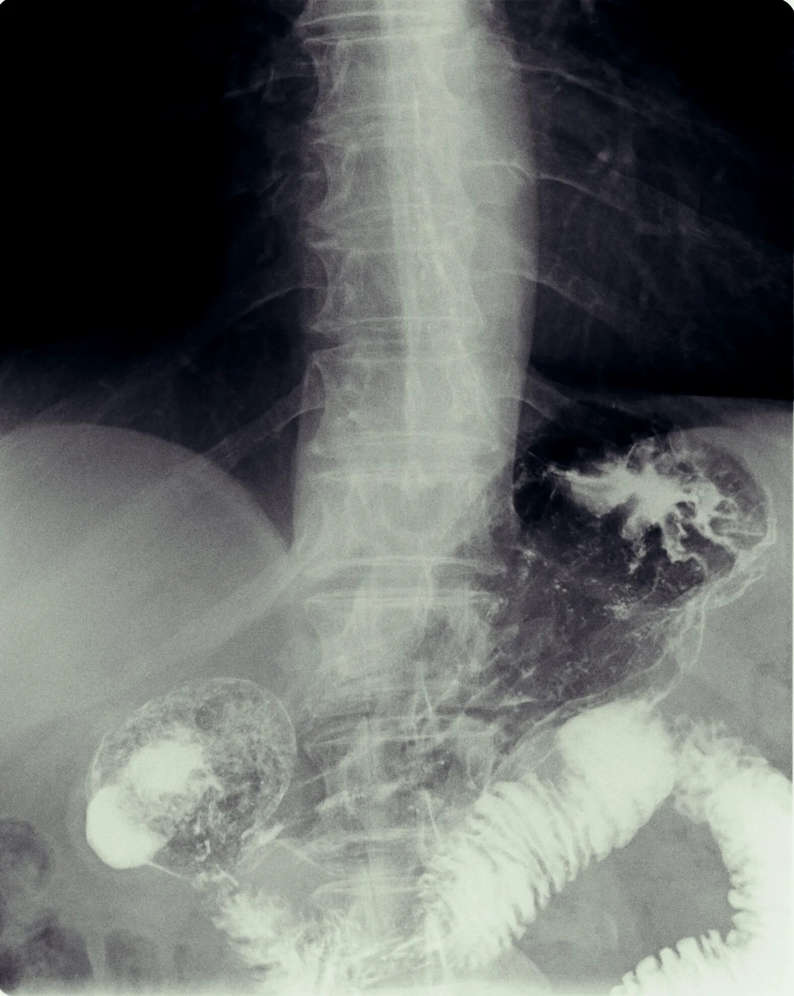 Рентгеноскопия желудка и ДПК. Полипозиционная рентгеноскопия желудка. Пролабирование пищевода. Рентгенография пищевода желудка и ДПК.