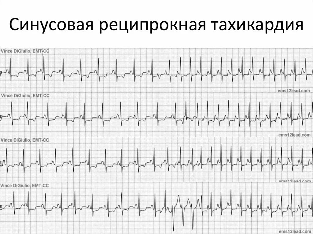 Пароксизм синусовой. Пароксизмальная наджелудочковая тахикардия экг. Пароксизм синусовой. Пароксизм синусовой. Пароксизм синусовой.