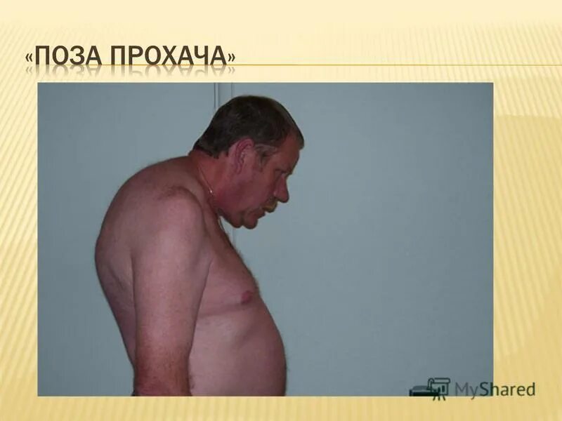 Болезнь бехтерева грудины. Болезнь бехтерева поясничный отдел позвоночника. Синдромы при болезни бехтерева. Болезнь бехтерева поясничного отдела. Болезнь бехтерева штрюмпеля мари.