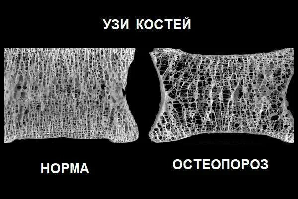Исследование плотности костей. Узи плотности костной ткани. узи костей остеопороз. остеопороз на снимке. ультразвуковое исследование костей.