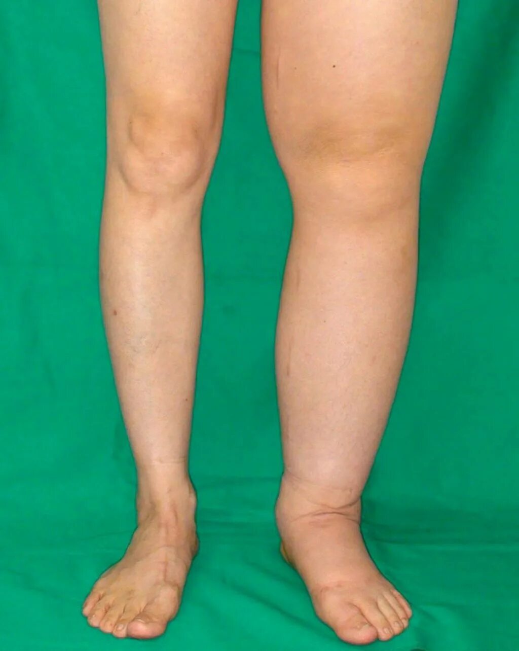 Ноги выше колена. Хронический лимфостаз лимфедема. Лимфедема рожистое воспаление.