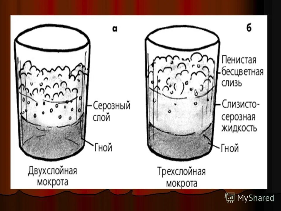 Серозная пенистая мокрота. Трехслойная мокрота при. Отстаивание мокроты. Слизисто серозная мокрота.