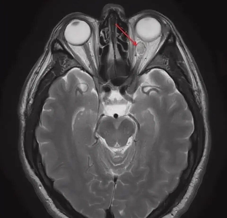 Мрт глазного нерва. Глиома зрительного нерва мрт. Глиомы зрительных нервов. Хиазма зрительных нервов мрт.