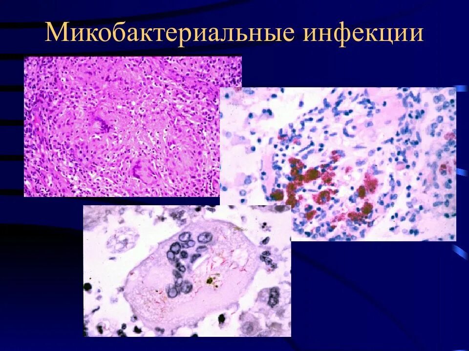Кишечные инфекции патологическая анатомия. Кишечные инфекции патологическая анатомия. Брюшной тиф пейерова бляшка микропрепарат. Кишечные инфекции патологическая анатомия. Кишечные инфекции патологическая анатомия.